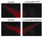 Hsp104 from yeast protects against alpha-synuclein toxicity in the rat brain. Red staining shows the levels of an enzyme involved in dopamine synthesis in the region of the rat brain most affected in Parkinson's disease (controls, left top and bottom). Rats were injected with viruses expressing alpha-synuclein & YFP (right top) or alpha-synuclein and Hsp104 (right bottom). Note the increased survival of dopamine-producing neurons in the rat brain injected with Hsp104 (right bottom) compared to rat brain without Hsp104 (right top).